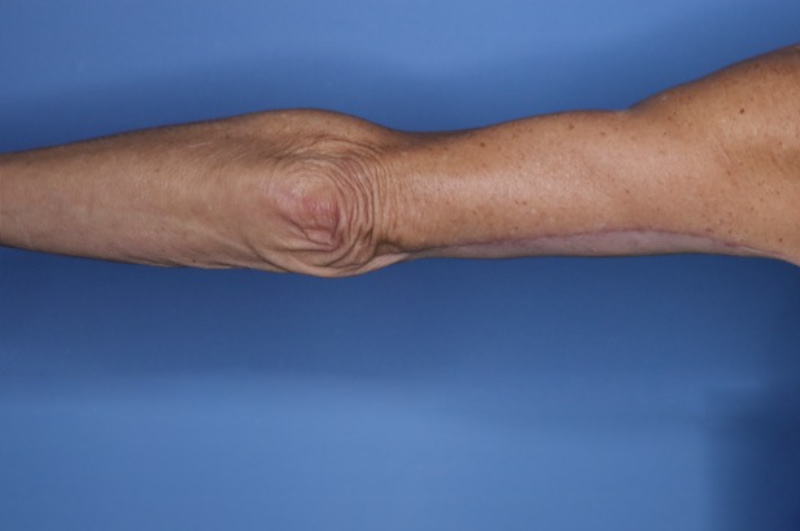 Brachioplasty Before & After Patient 03