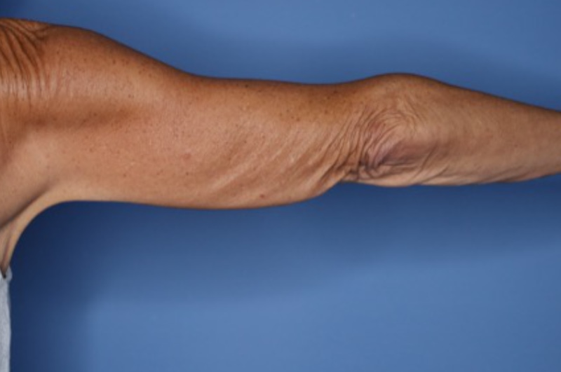 Brachioplasty Before & After Patient 03