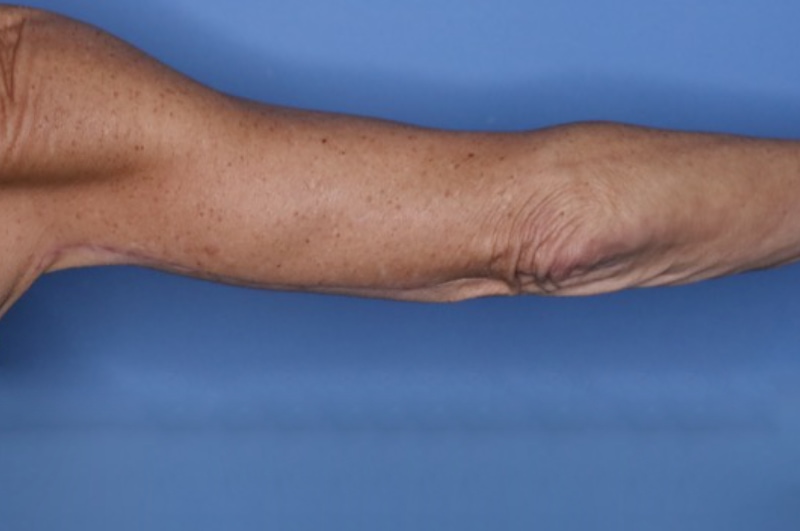 Brachioplasty Before & After Patient 03