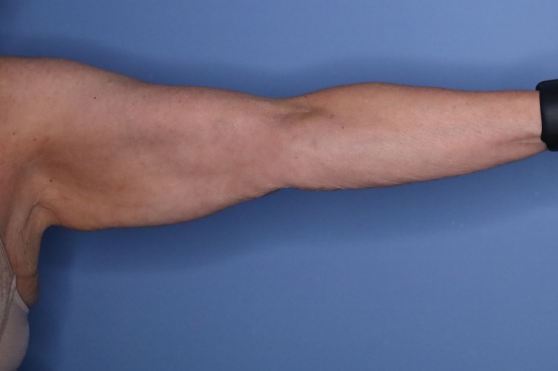 Brachioplasty Before & After Patient 04