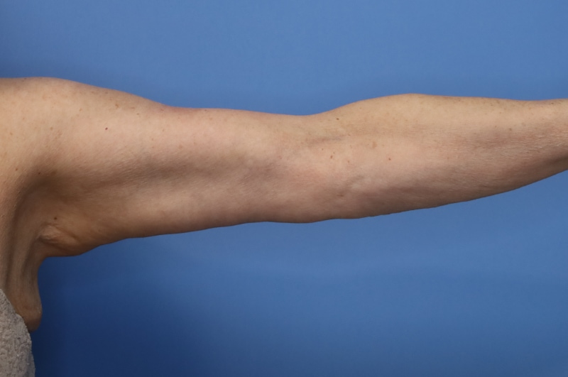 Brachioplasty Before & After Patient 04