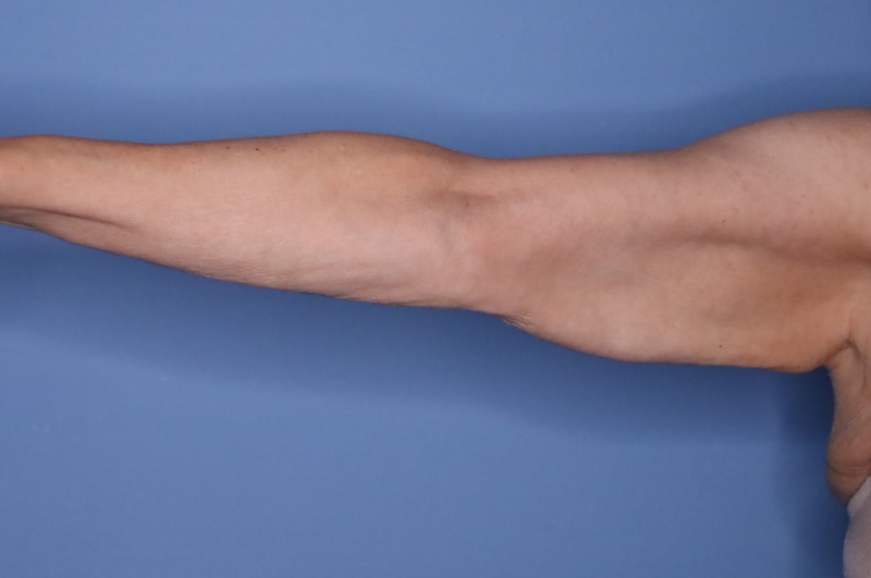 Brachioplasty Before & After Patient 04