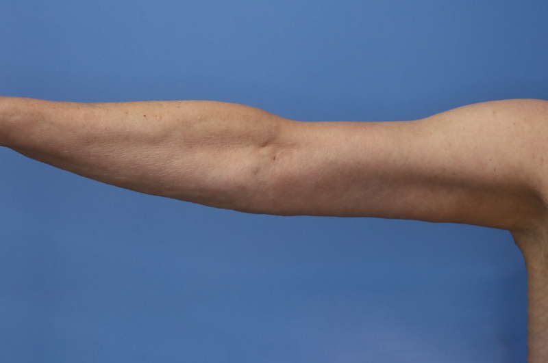 Brachioplasty Before & After Patient 04