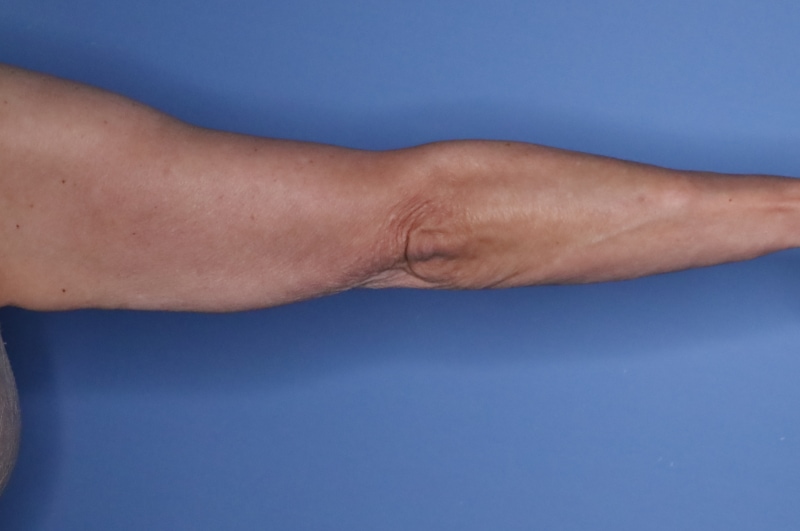 Brachioplasty Before & After Patient 04