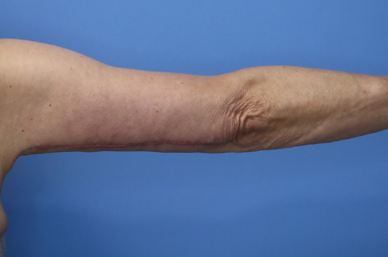 Brachioplasty Before & After Patient 04