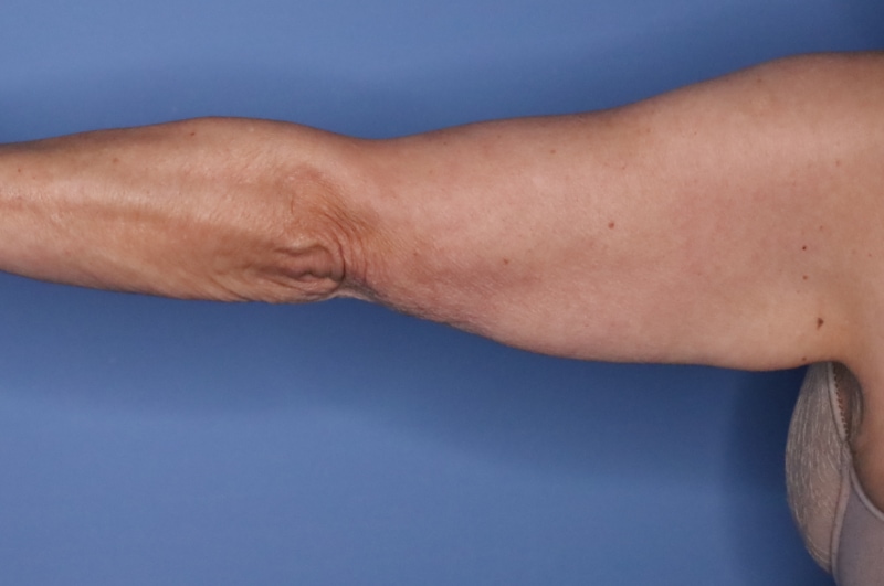 Brachioplasty Before & After Patient 04
