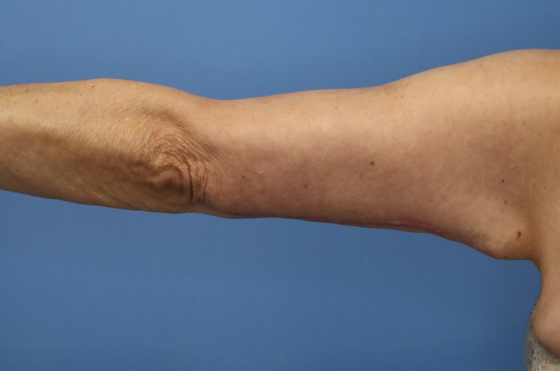 Brachioplasty Before & After Patient 04