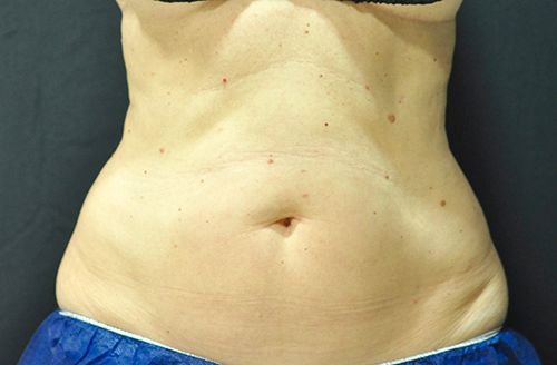 Coolsculpting Before & After Photo Patient 01 Thumbnail