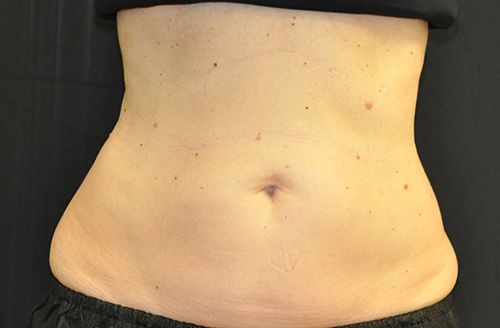 Coolsculpting Before & After Patient 01