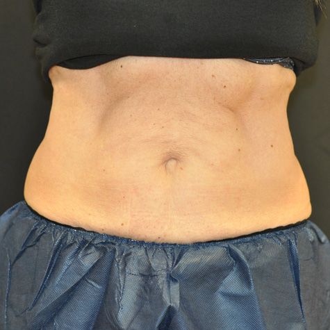 Coolsculpting Before & After Photo