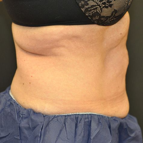 Coolsculpting Before & After Patient 03