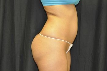 Liposuction Before & After Photo Patient 02 Thumbnail