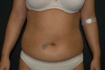 Liposuction Before & After Photo Patient 03 Thumbnail