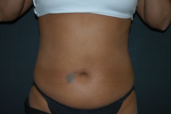 Liposuction Before & After Photo Patient 03 Thumbnail