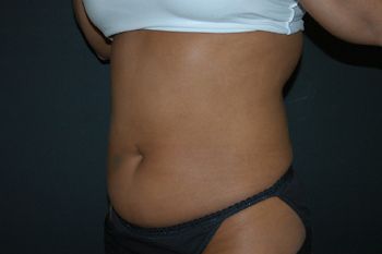 Liposuction Before & After Photo Patient 03 Thumbnail