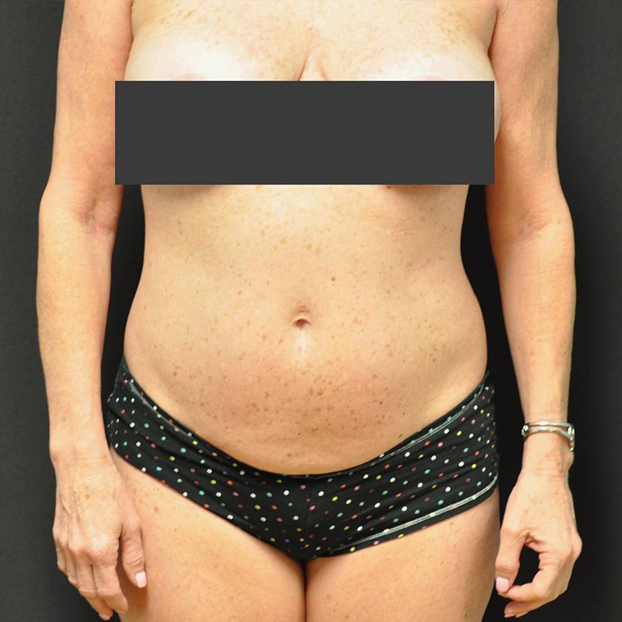 Liposuction Before & After Photo Patient 04 Thumbnail