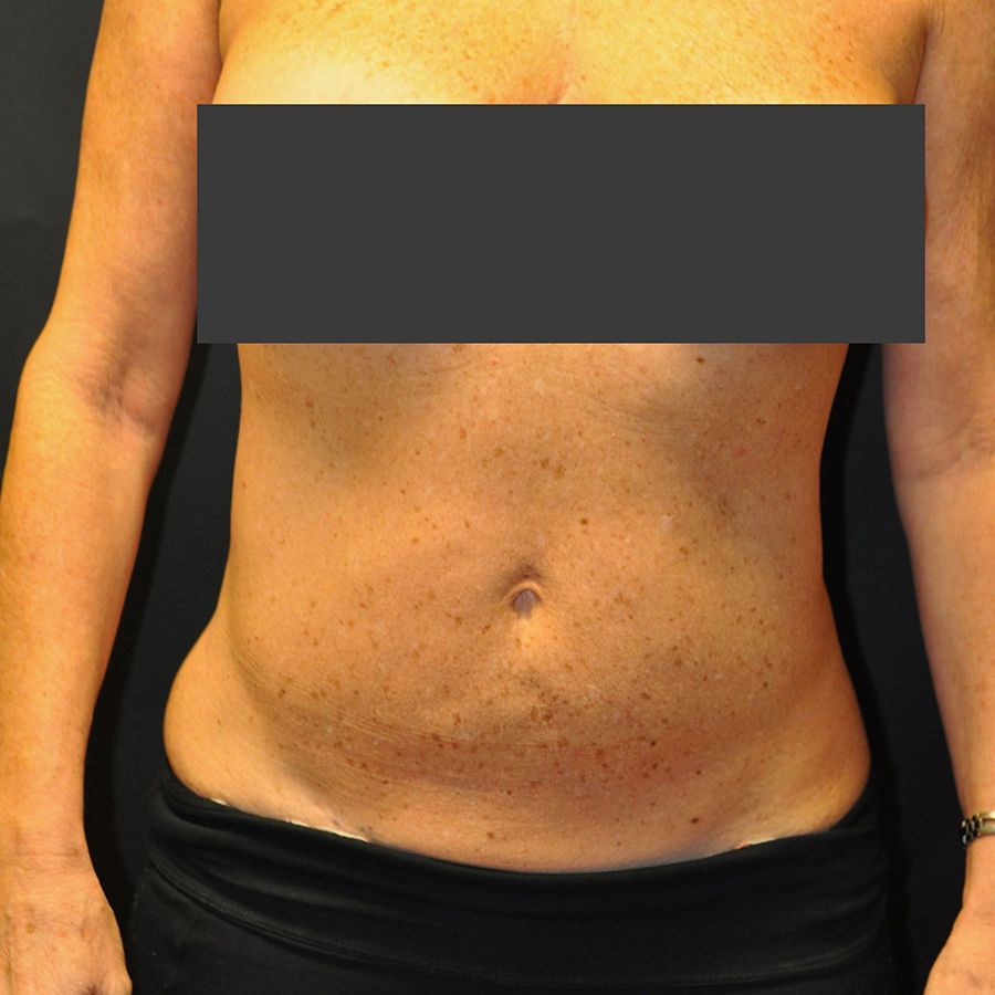 Liposuction Before & After Photo Patient 04 Thumbnail