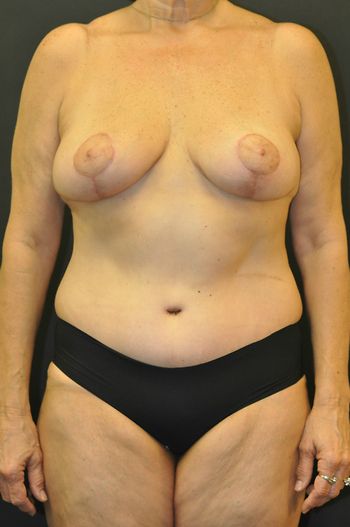 Mommy Makeover Before & After Patient 03