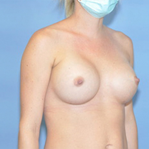 Breast Augmentation Before & After Patient 01