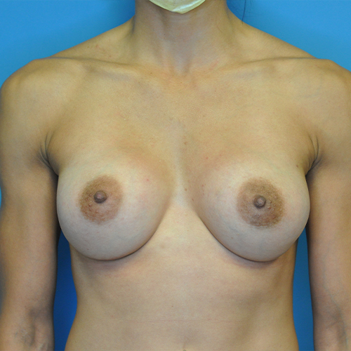 Breast Augmentation Before & After Photo Patient 02 Thumbnail