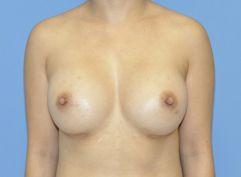 Breast Augmentation Before & After Photo Patient 04 Thumbnail