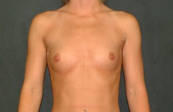 Breast Augmentation Before & After Patient 07