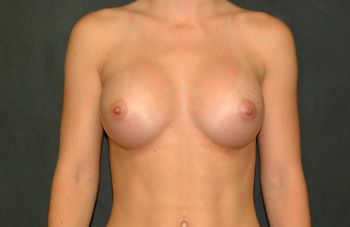 Breast Augmentation Before & After Patient 07