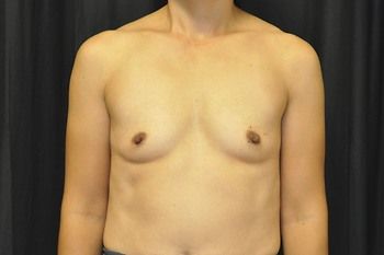 Breast Augmentation Before & After Patient 09