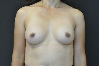 Breast Augmentation Before & After Patient 09