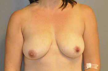 Breast Augmentation Before & After Patient 102
