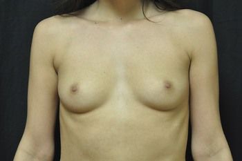 Breast Augmentation Before & After Patient 103