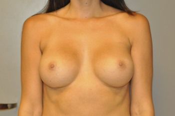 Breast Augmentation Before & After Patient 103