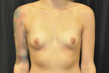 Breast Augmentation Before & After Patient 104