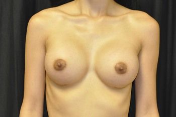 Breast Augmentation Before & After Photo Patient 105 Thumbnail