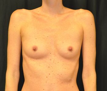 Breast Augmentation Before & After Patient 108