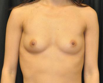 Breast Augmentation Before & After Patient 109