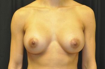 Breast Augmentation Before & After Patient 112