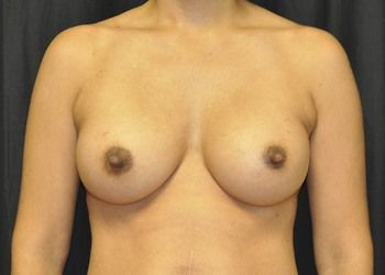 Breast Augmentation Before & After Patient 113
