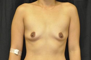 Breast Augmentation Before & After Patient 115