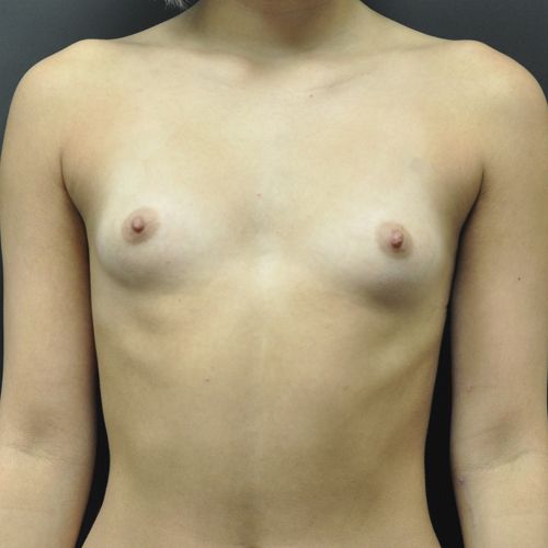 Breast Augmentation Before & After Photo Patient 118 Thumbnail