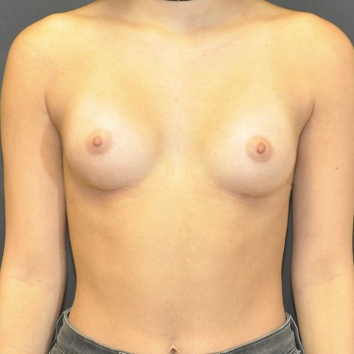 Breast Augmentation Before & After Photo Patient 118 Thumbnail