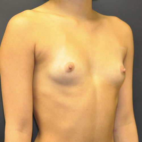 Breast Augmentation Before & After Photo Patient 118 Thumbnail