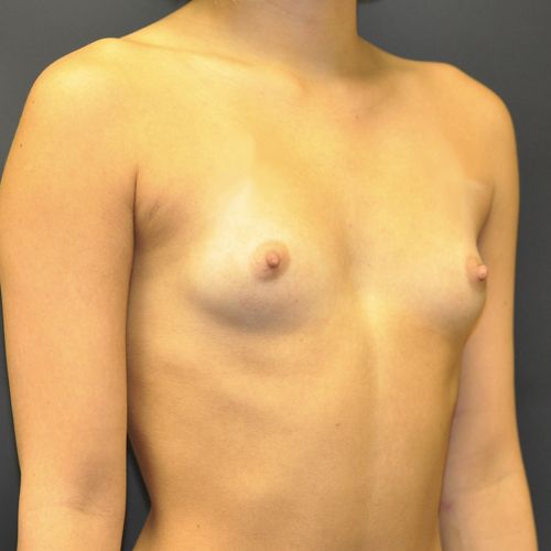 Breast Augmentation Before & After Patient 118