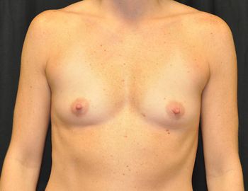 Breast Augmentation Before & After Patient 12