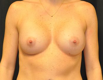 Breast Augmentation Before & After Photo Patient 12 Thumbnail