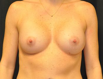 Breast Augmentation Before & After Patient 12