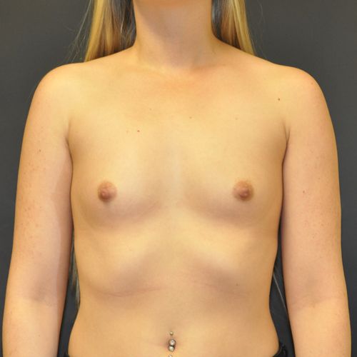 Breast Augmentation Before & After Photo Patient 121 Thumbnail
