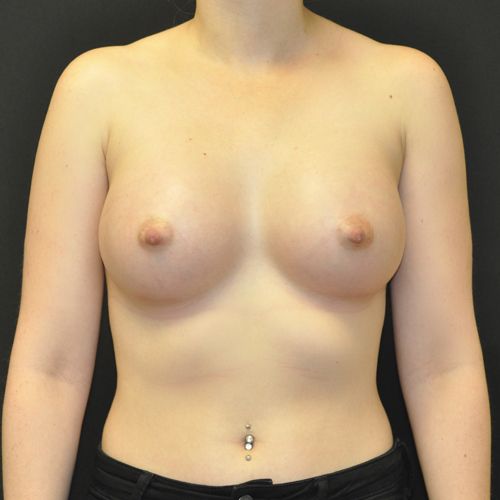 Breast Augmentation Before & After Photo Patient 121 Thumbnail