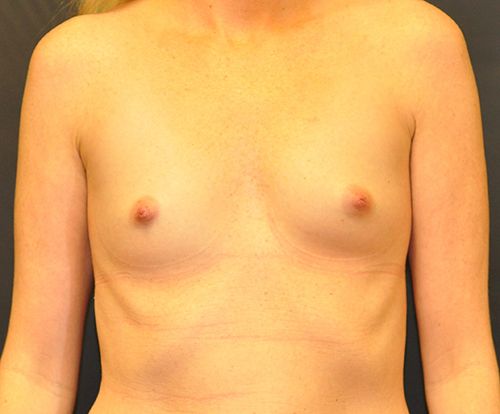 Breast Augmentation Before & After Patient 122