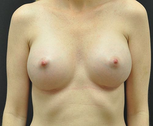 Breast Augmentation Before & After Patient 122